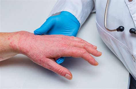 Eczema in Psoriasis Patients Treated with IL-17 Inhibitor - Dermatology Advisor