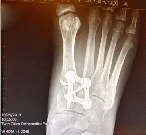 After LisFranc Surgery: Bones fully healed!!!