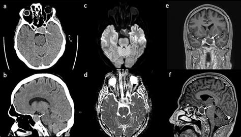 Pituitary Apoplexy in Macroadenoma After Minor Surgery: An Unusual Case and Literature Review