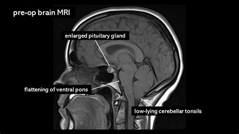 Pituitary Tumor Mri