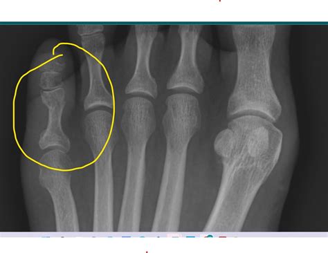 Displaced or Nondisplaced Toe Fracture ? (Revised w/ 3 views) : r/xrays