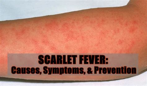 SCARLET FEVER - This health condition also known as scarlatina which is ...