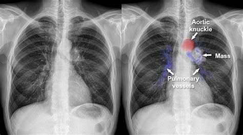 Chest X-ray - Mediastinum and hilum - Unilateral hilar enlargement