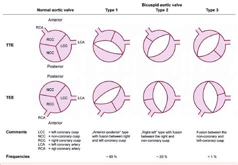 Anatomical types of bicuspid aortic valve (BAV) according to a classifi ...