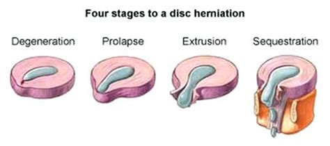 Four Stages to a Disc #Herniation: #Degeneration, Prolapse, Extrusion, Sequestration. Get # ...