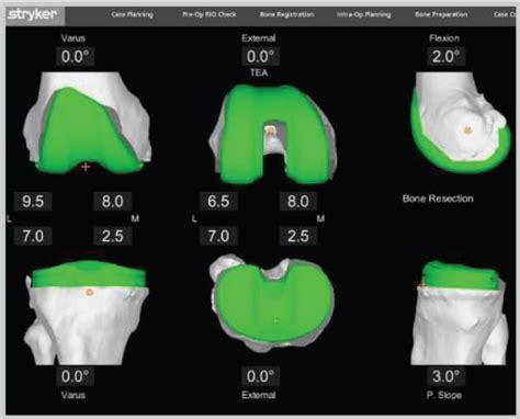 Mako Robotic-Arm Assisted Technology – Andrew Yun MD