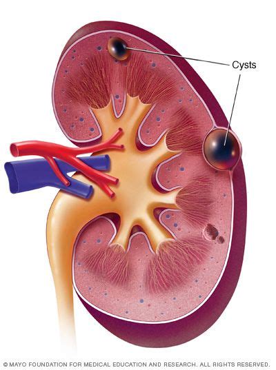 48 best images about Kidney Cyst on Pinterest | Cyst on kidney, Kidney disease and Dialysis