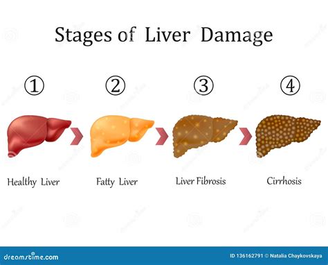 Stages of Liver Damage, Liver Disease. Healthy, Fatty, Liver Fibrosis ...