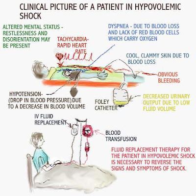 Dear Nurses: HYPOVOLEMIC SHOCK