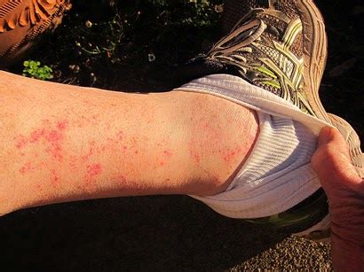 Hot weather hiking affliction: Golfer's Vasculitis