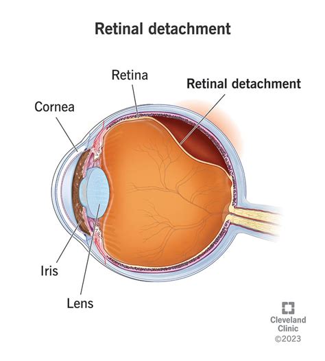 Retinal Detachment: Symptoms & Causes