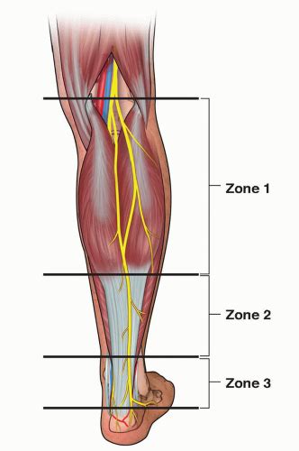 Achilles Tendon Lengthening | Musculoskeletal Key