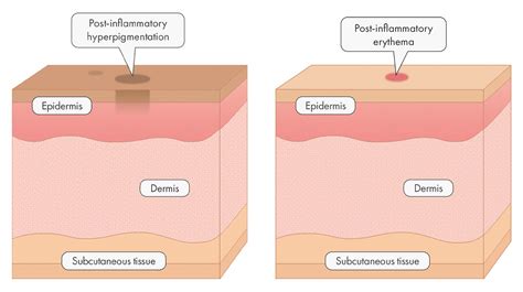 post inflammatory erythema treatment - Pregnancy Informations