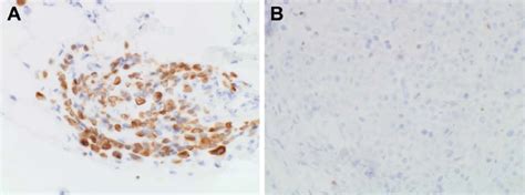 Omental malignant mesothelioma. A. The tumor cells are reactive with... | Download Scientific ...