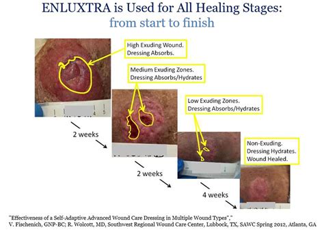 Wound Exudate Reduction - ENLUXTRA