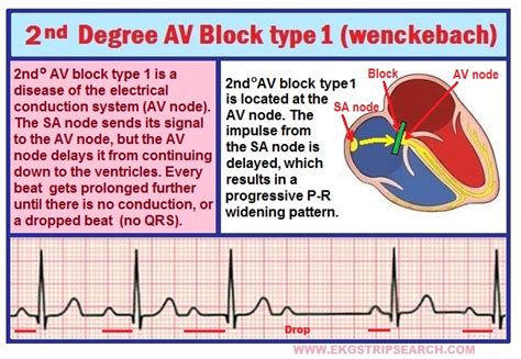 2nd Degree Av Block Mobitz Type 2 Pictures to Pin on Pinterest - PinsDaddy