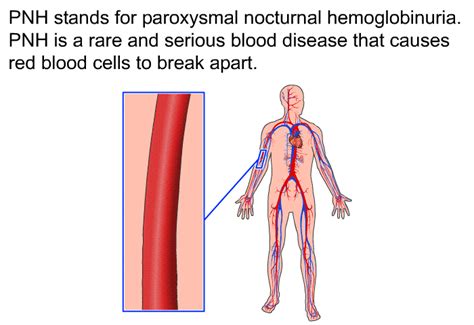 PatEdu.com : PNH - Paroxysmal Nocturnal Hemoglobinuria