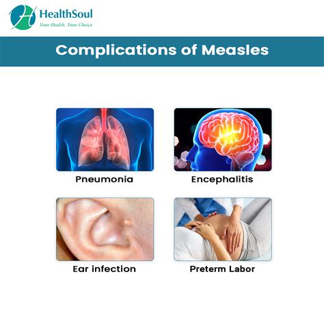 Measles: Symptoms and Treatment – Healthsoul