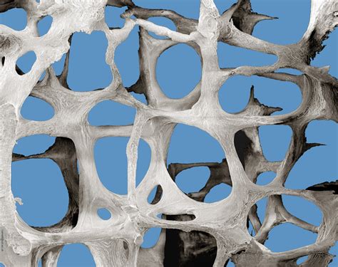 Scanning Electron Microscopy of osteoporotic bone - Bone Research Society