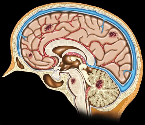 What is brain cavernoma and its causes?