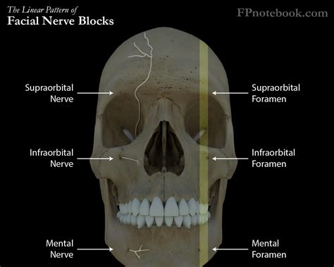 Infraorbital Nerve Block