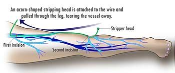 Conventional Treatment for Varicose Veins - Vein Solutions