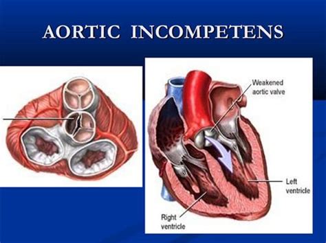 the picture of leaky aortic heart valve leakage | Heart valves, Valve, Health problems