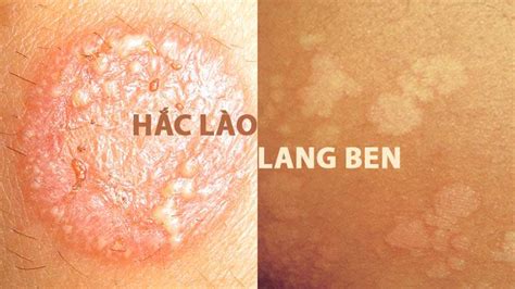 Hắc Lào – Lang Ben: Phân Biệt Và Cách Điều Trị Bệnh