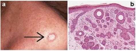 Infundibulocystic Basal Cell Carcinoma. a) skin lesion; b) histology ...