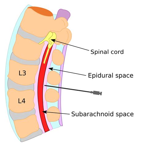 Living with Cerebral Spinal Fluid Leaks | Hawaii Reporter