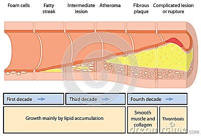 Atheroma Formation Stock Vector - Image: 61318147