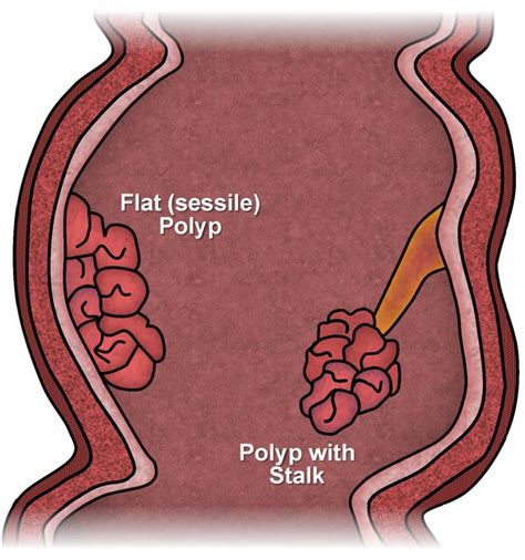 Polyps of the Colon and Rectum | ASCRS