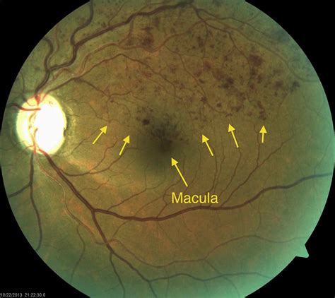 Treatment for Macular Edema Caused by Branch Retinal Vein Occlusion