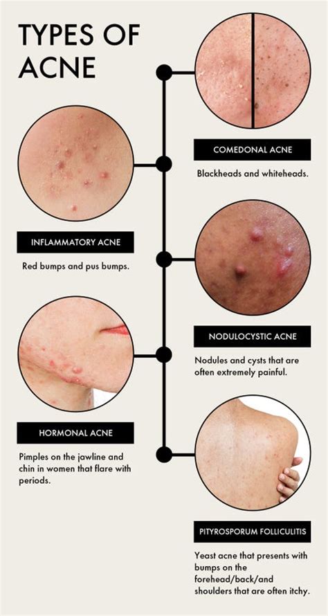 Acne Cyst Chin