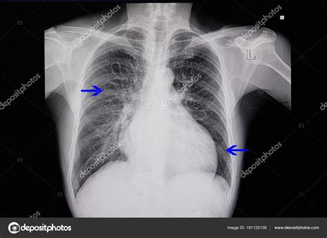 Chest Ray Patient Heart Failure Showing Cardiomegaly Pulmonary Congestion — Stock Photo ...