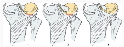 Discoid Meniscus - Frisco, TX - Knee, Hip, Shoulder, Joint Surgery