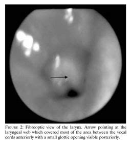 Laryngeal web associated with Simpson-Golabi-Behmel syndrome in a child ...