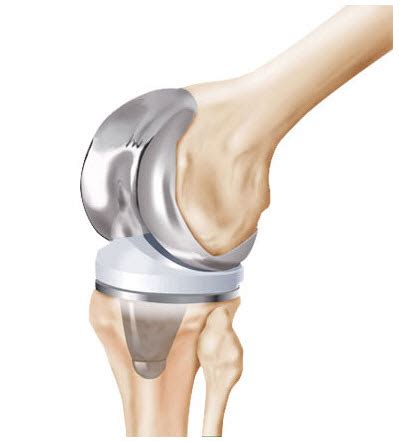 Zimmer Knee Replacement Recall - NexGen Complications & Recalls