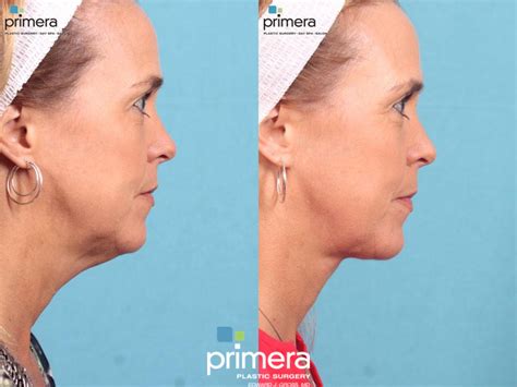 Neck & Face Liposuction Before & After Photos Patient 462 | Orlando, Florida | Primera Plastic ...