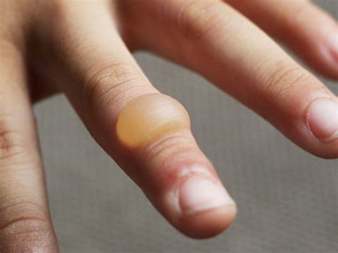 Burn blister: First aid, treatment, and types of burns