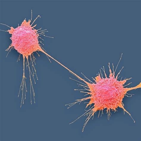 Olaparib could be more effective than standard care for some prostate cancers - Oncology Central