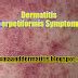 Dermatitis Herpetiformis Symptoms - Eczema and Dermatitis