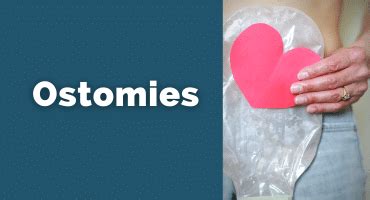 Ostomies - Gastrointestinal Society