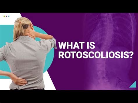 Rotoscoliosis: What Is It? Causes, Symptoms, and Treatment