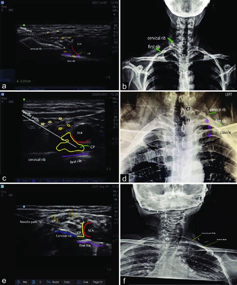 (a): Ultrasound image showing the right supraclavicular scan with the... | Download Scientific ...