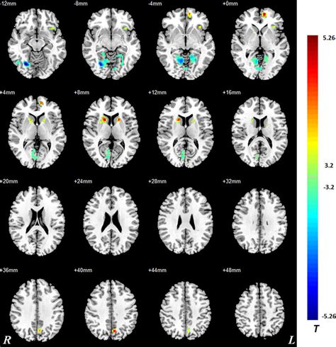 ALFF values using two-sample t-tests during resting-state. Decreased ...