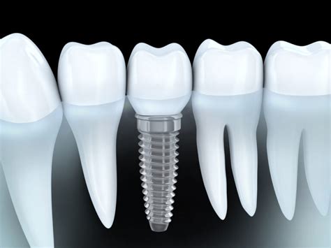 Dental Implants Kitchener | Dental Implants Near Me Kitchener