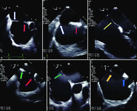 Transesophageal echocardiogram delineating the margin of the atrial ...