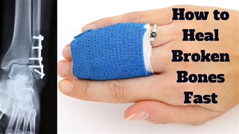 How to Heal Broken Bones Fast - YouTube