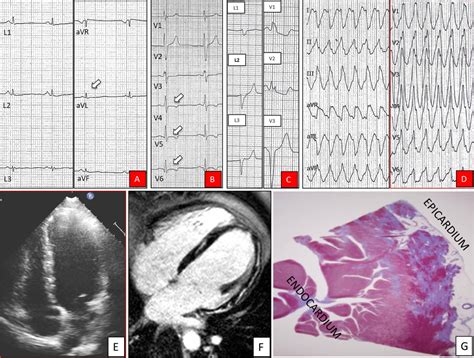 Arrhythmogenic left ventricular cardiomyopathy | Heart